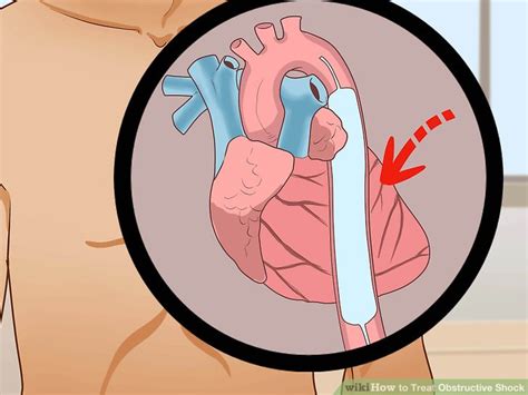 How To Treat Obstructive Shock 13 Steps With Pictures Wikihow Health