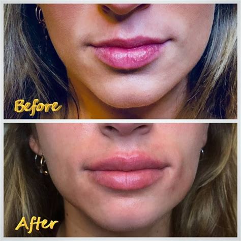 Lip Flip Enhance Your Smile With This Simple Treatment