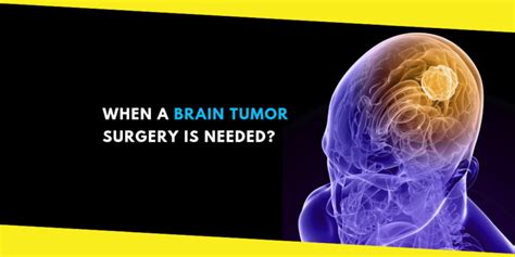 How To Know When A Brain Tumor Surgery Is Needed