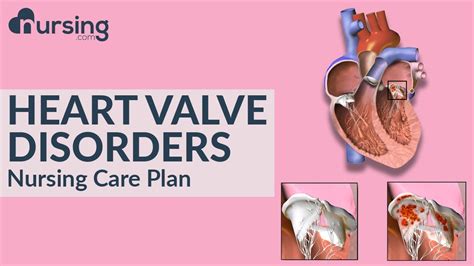 How Heart Valve Disorders Occur And Caring For Heart Valve Disorders