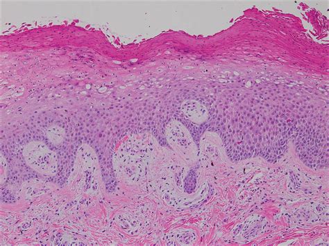 Acrodermatitis Enteropathica In A Patient With Short Bowel Syndrome