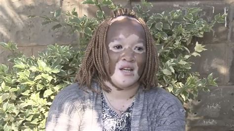 Kenyan Woman Helps People Living With Vitiligo Cgtn