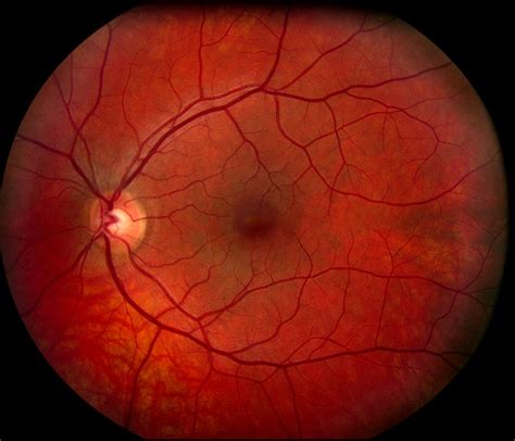 Age Related Macular Degeneration Amd Diagnosis Treatment And