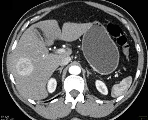 Focal Nodular Hyperplasia Fnh Liver Case Studies Ctisus Ct Scanning