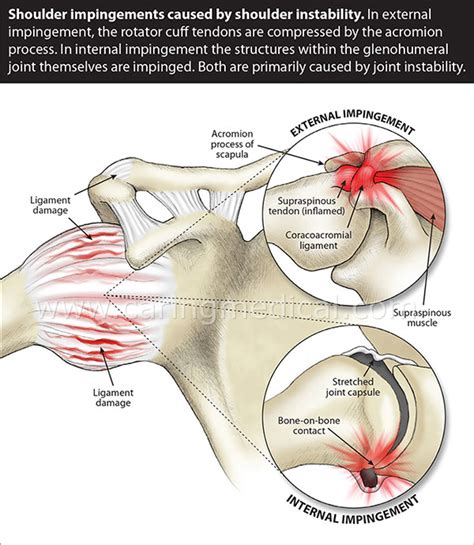 In reality there are several different internal impingement is a different beast. Prolotherapy for Swimmer's Shoulder | Prolotherapy.org