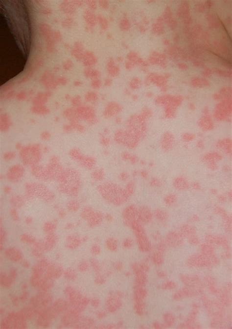 How Can You Tell If Your Rash Needs Medical Attention Qooly