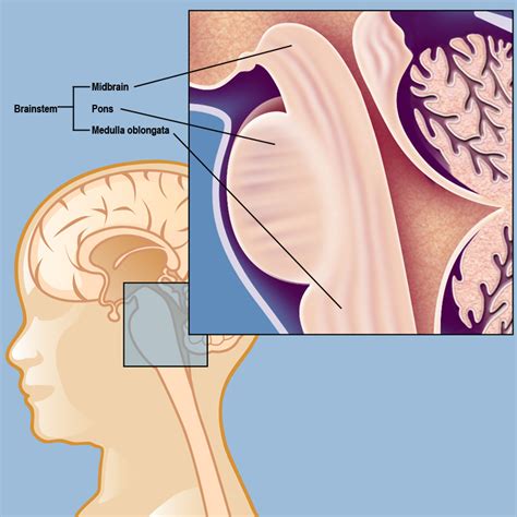 The international and european society for pediatric oncology dipg registries collaborated to. Diffuse Intrinsic Pontine Glioma (DIPG) | Weill Cornell ...