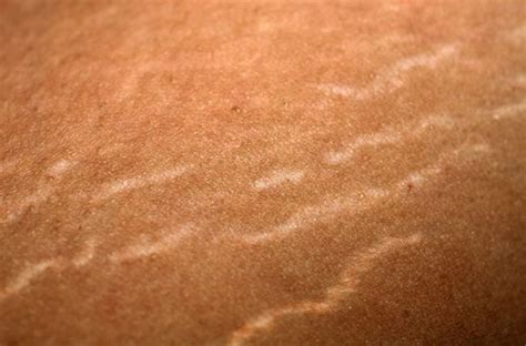 What You Should Know About Stretch Marks On The Breasts Cleveland Clinic