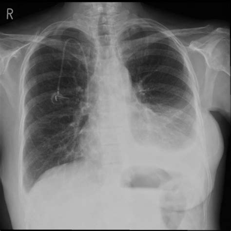 The precise pathophysiology of fluid accumulation varies the plain chest radiographic features of pleural effusion are usually characteristic. Malignant pleural effusion - Radiology at St. Vincent's ...