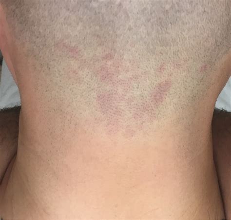 Rash On Back Of Neck After Haircut Best Haircut 2020