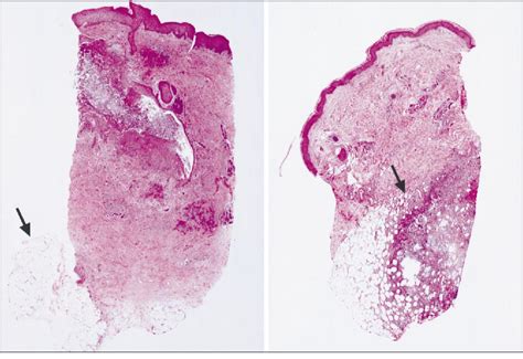 Figure 3 From Cutaneous Aspergillosis And Acquired Immunodeficiency