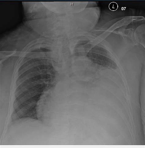 Admission Chest Radiography Showing Enlarged Cardiac Silhouette And