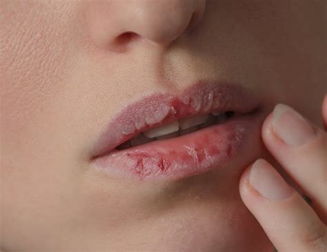 problemas en los labios causas y remedios blistex