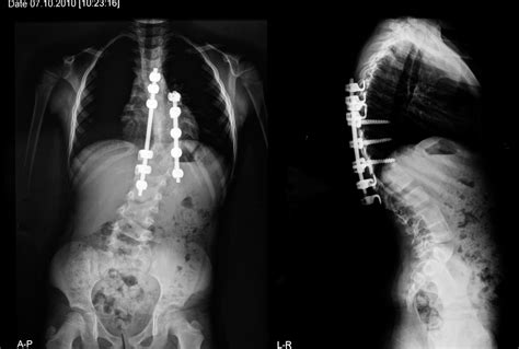 Scoliosis Symptoms Archives Spinal Backrack