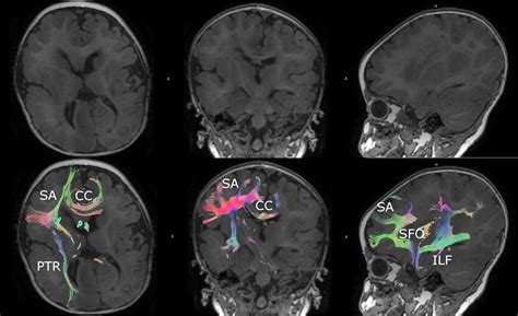 Cureus Diffusion Tensor Imaging In An Infant Undergoing Functional Hemispherectomy A Surgical Aid