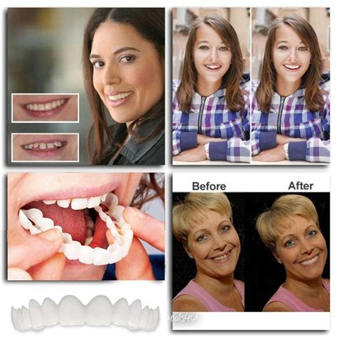 Snap On Smile Instant Smile Veneer Snap On Smile Perfect Smile