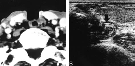 Sonographic Findings Of The Neopharynx After Total Laryngectomy