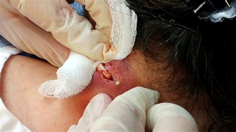 Draining Cyst On Back Of Neck Best Drain Photos Primagemorg
