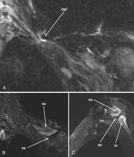 Imaging For Peripheral Nerve Disorders Neupsy Key