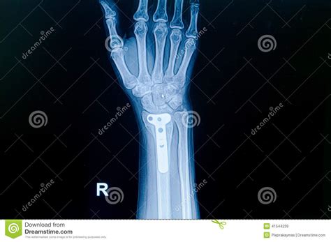 X Ray Of Human Hand With Broken Wrist Fracture Of Radius