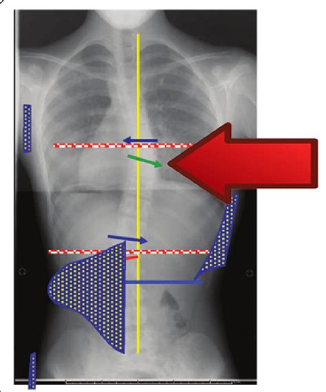 Null Point On The Radiological Apex Of The Curve At The Red Arrow Level