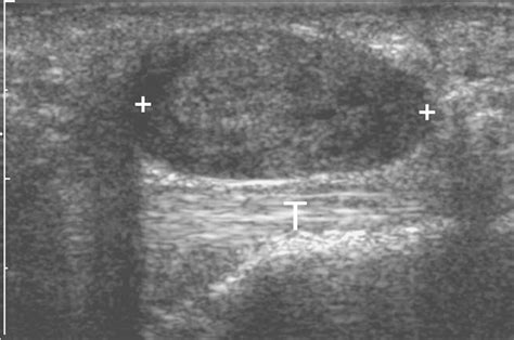 Giant Cell Tumors Of The Tendon Sheath Analysis Of Sonographic