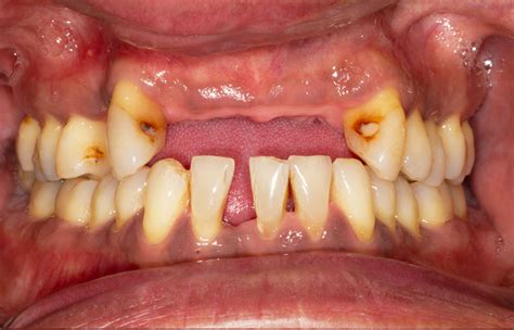Gum Disease Symptoms And Treatment Cuckfield Dental