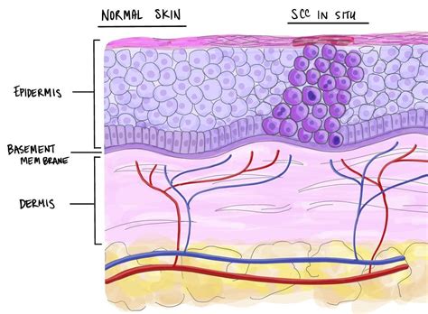 Skin Cancer Histology