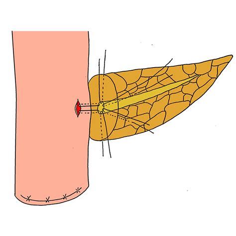 One Layered Technique 4 The Pancreatic Anastomosis
