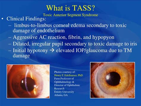 Toxic Anterior Segment Syndrome