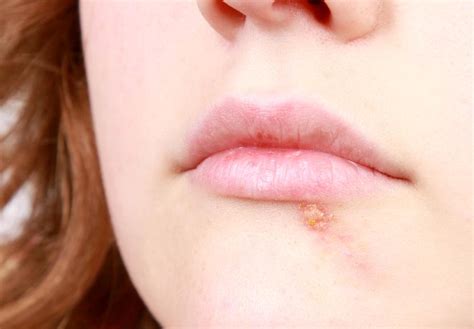 8 Critical Cold Sore Stages