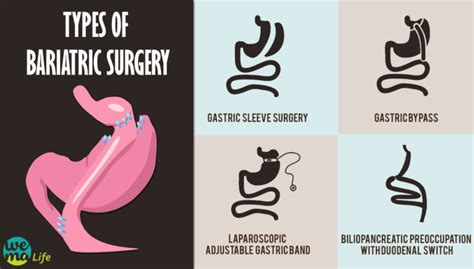 Bariatric Surgery Know How It Works
