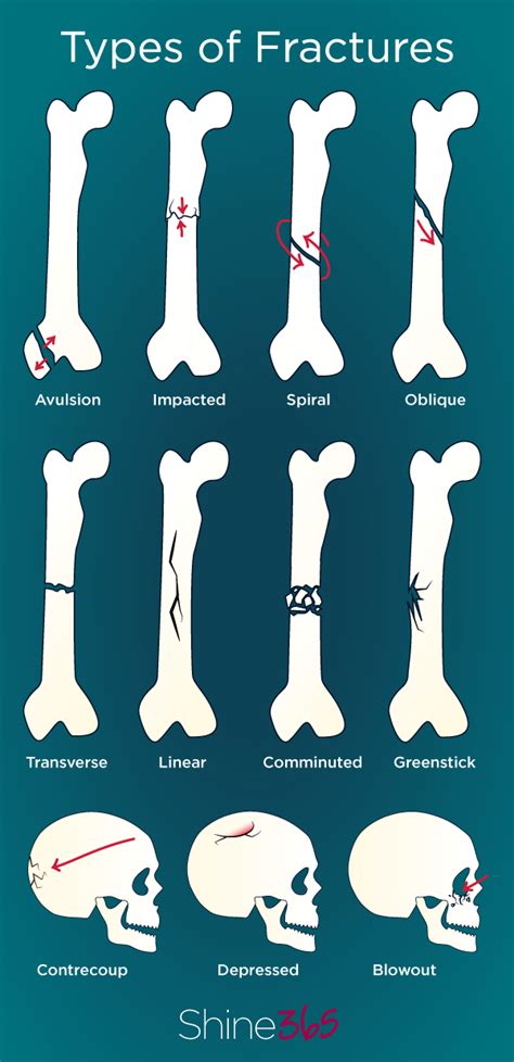 Types Of Broken Bone Fractures