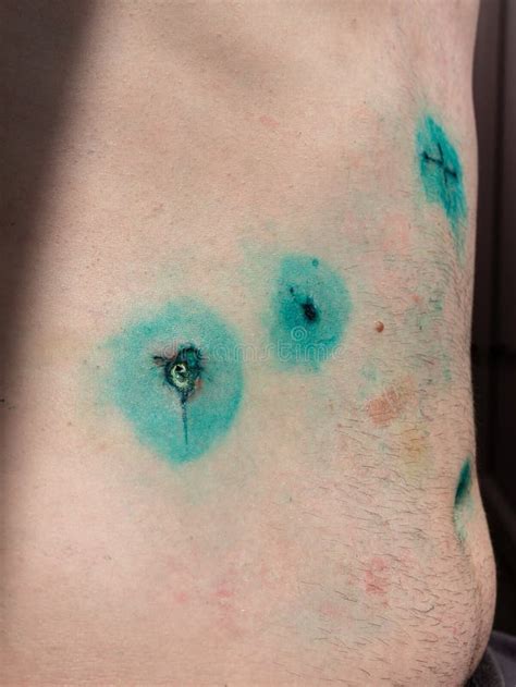 Male Body With Incisions After Gallbladder Laparoscopic Surgery