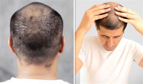 Hair Loss Treatment Hair Loss Treatment A Four Minute Scalp Massage Daily Could Promote
