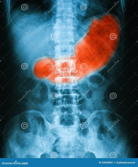 X Ray Image Of Abdomen Supine Position Stock Image Image Of Gastric