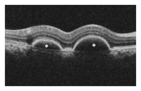 Fundus Photos And Oct Scans For A Patient With Bilateral Pcv A