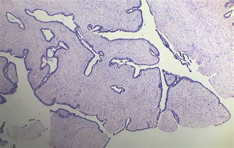 Phyllodes Tumour Histo H And E 10x Download Scientific Diagram