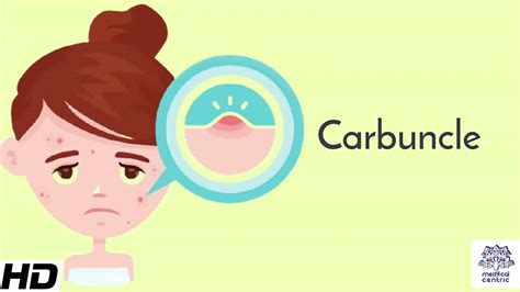 Carbuncle Causes Signs And Symptoms Diagnosis And Treatment Youtube