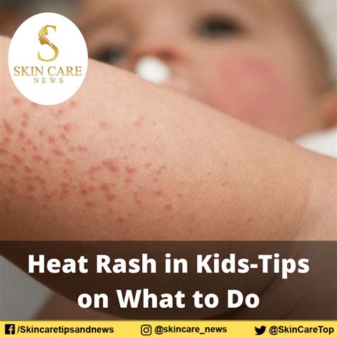 Heat Rash In Kids Tips On What To Do