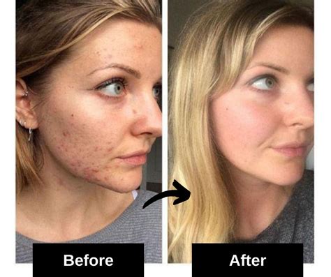 15 Most Effective Home Remedies For Acne Scars 2022 Fabbon