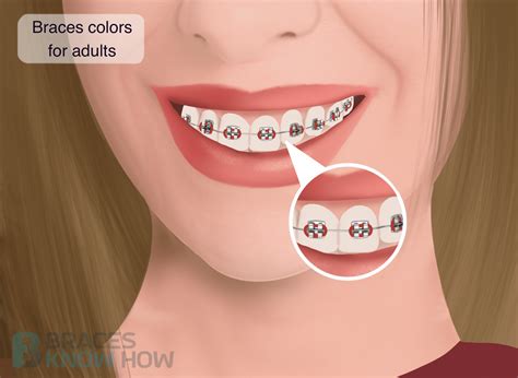 Best Braces Colors For Adults Which One Is You