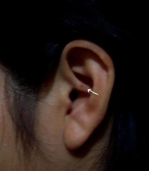 The pain and marks completely go away within 48 hours. Pin Dot & Scoop Marks, & Other Mysterious Body Markings ...