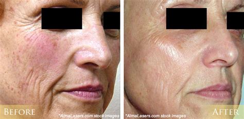 Ipl Photofacial Before And After Pictures Morehead City