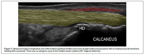 Retrocalcaneal Bursitis Ultrasound