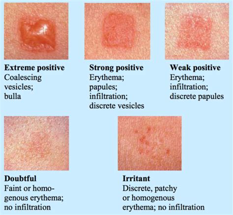 Suddenly Allergic Artical Contact Dermatitis Patch Testing Contact