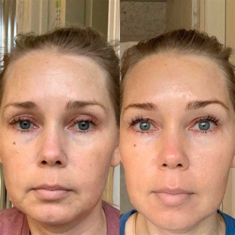 The Process Tretinoin Before And After Musely