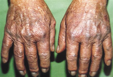 Extensive Bluish Gray Skin Pigmentation And Severe Arthropathy
