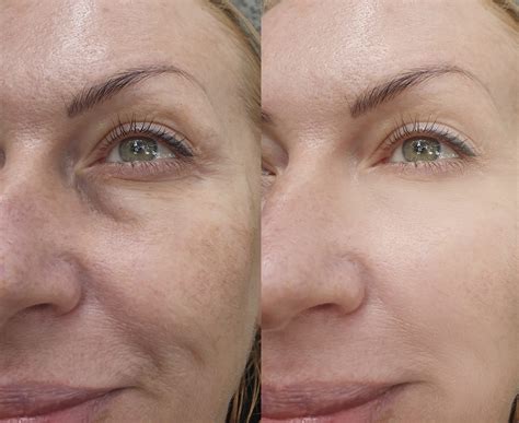 CO Laser Skin Resurfacing Prity Skincare