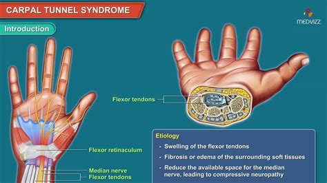 Carpal Tunnel Syndrome Animation Etiology Symptoms Diagnosis